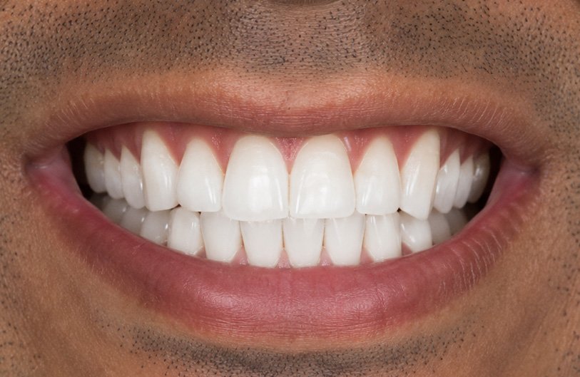 Laser Teeth Whitening After Treatment