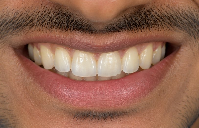 Smile Line & Edge Alignment After Treatment