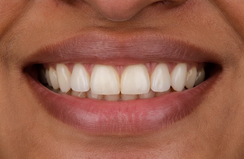 Midline Gap Closure After Treatment