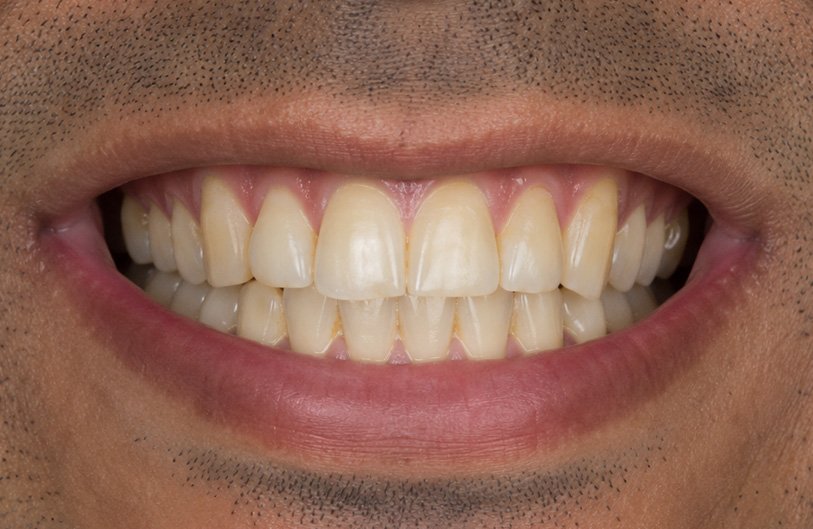 Laser Teeth Whitening Before Treatment