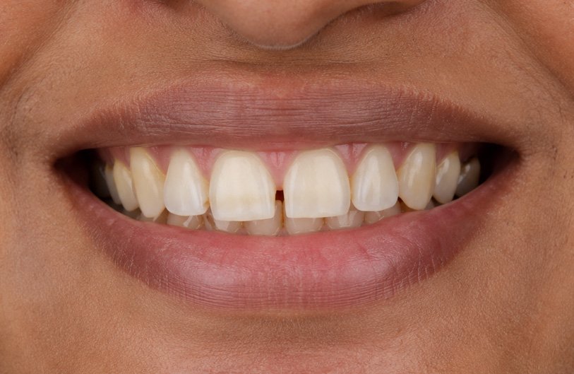 Midline Gap Closure Before Treatment